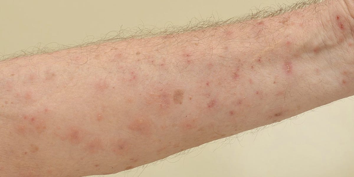 Scabies Control