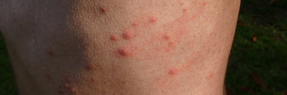 Bed Bug Bite Bed Bug Bite