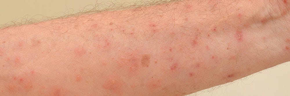 scabies inspection how to get rid of scabies